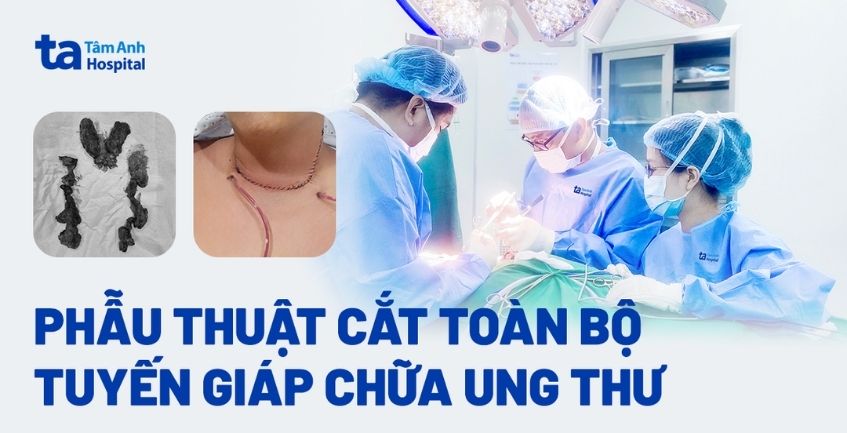 Phẫu thuật cắt bỏ toàn bộ tuyến giáp chữa ung thư