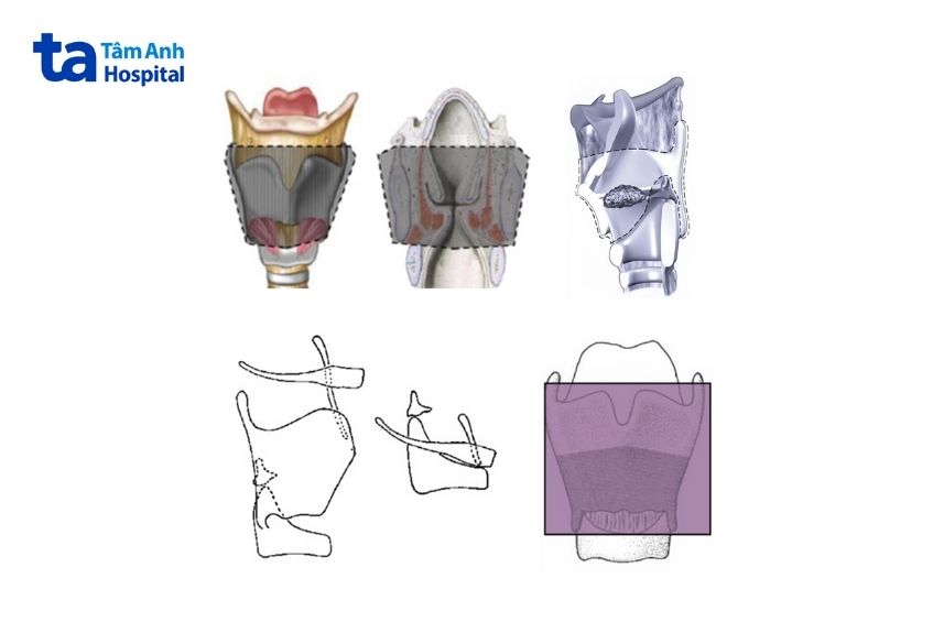 Phẫu thuật cắt thanh quản bán phần kiểu CHEP.