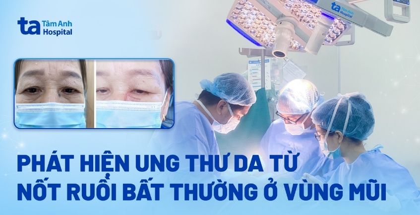 Ung thư da từ nốt ruồi bất thường ở mũi
