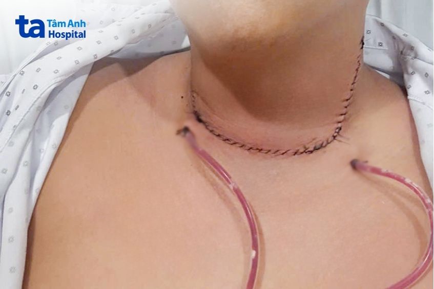 Vết mổ của anh Tùng khô ráo, giao tiếp trò chuyện với người thân bình thường, sức khỏe ổn định sau mổ.