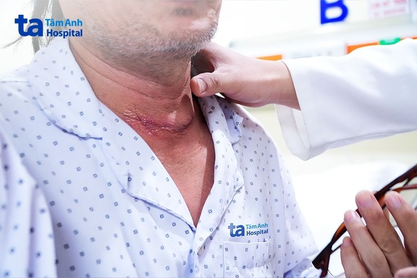 Vết sẹo mảnh, thẩm mỹ của bệnh nhân Hòa sau mổ ung thư tuyến giáp.