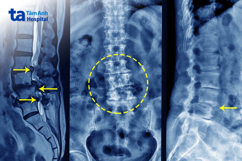 ảnh chụp đĩa đệm thoát vị gây hẹp ống sống