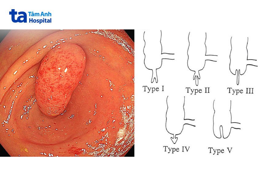 ảnh nội soi lồng ruột thừa