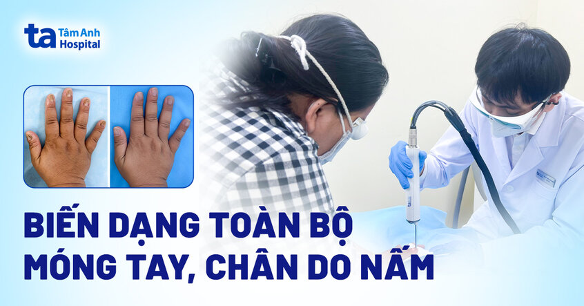 biến dạng toàn bộ móng do nấm
