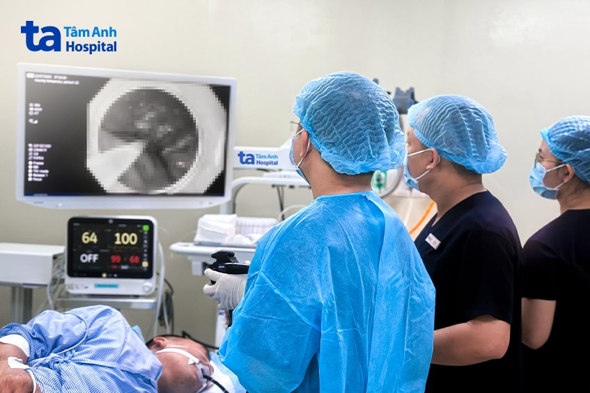 ca thắt tách khối u