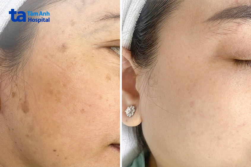 các đốm tàn nhang đã mờ đáng kể