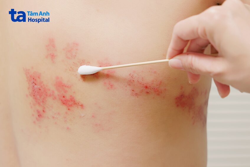 chăm sóc và theo dõi vết thương