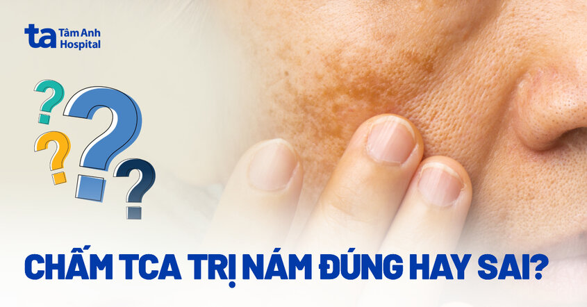 Chấm TCA trị nám đúng hay sai? Bị nám có nên lựa chọn không?