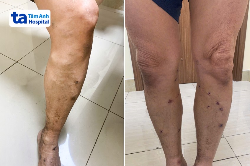 Chân ông Tám nổi nhiều mạch máu nhỏ, sạm da (bên trái) và sau khi điều trị suy giãn tĩnh mạch (bên phải)
