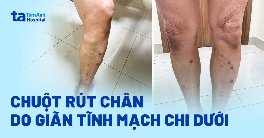 Chuột rút chân do giãn tĩnh mạch chi dưới