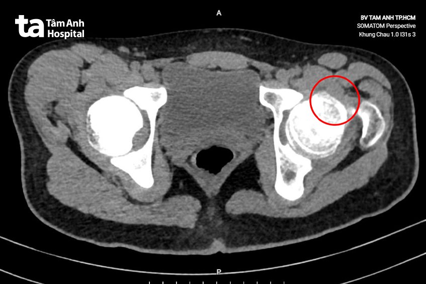 chụp ct khớp háng bên trái bệnh nhân