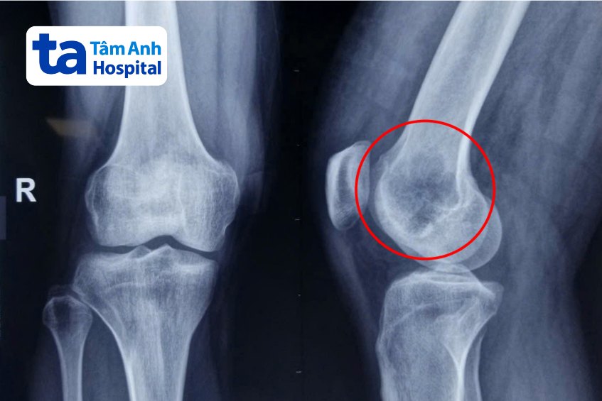 chụp x quang khớp gối khối u anh tài