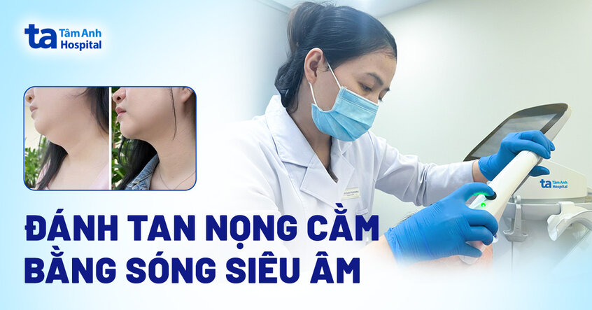 Đánh tan nọng cằm bằng sóng siêu âm