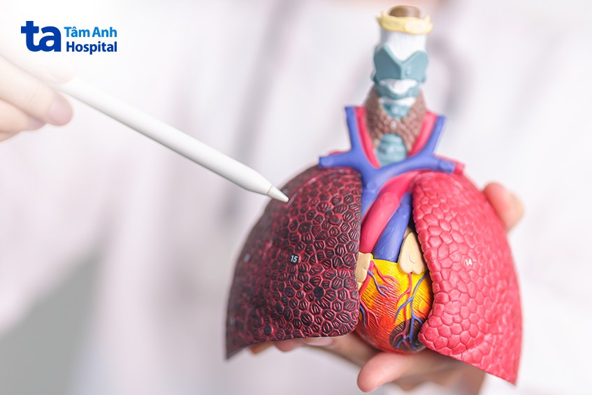 Dày dính màng phổi lan tỏa có thể lành tính hoặc ác tính