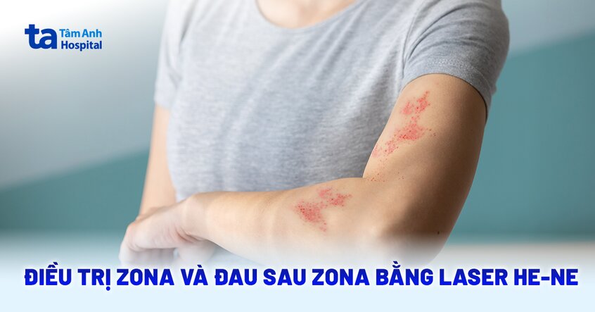 Quy trình điều trị zona bằng laser He-Ne có hiệu quả không?
