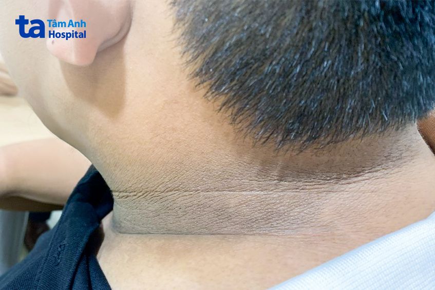 gai đen quanh cổ bệnh nhân béo phì