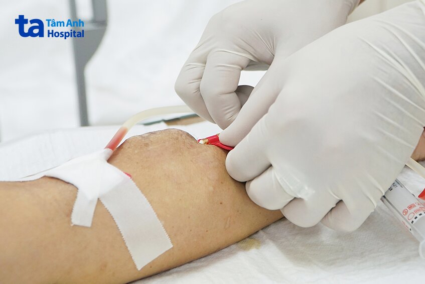 gắn cầu tay chạy thận