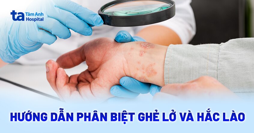 Ghẻ lở hắc lào là gì? Bảng phân biệt chi tiết, dễ hiểu
