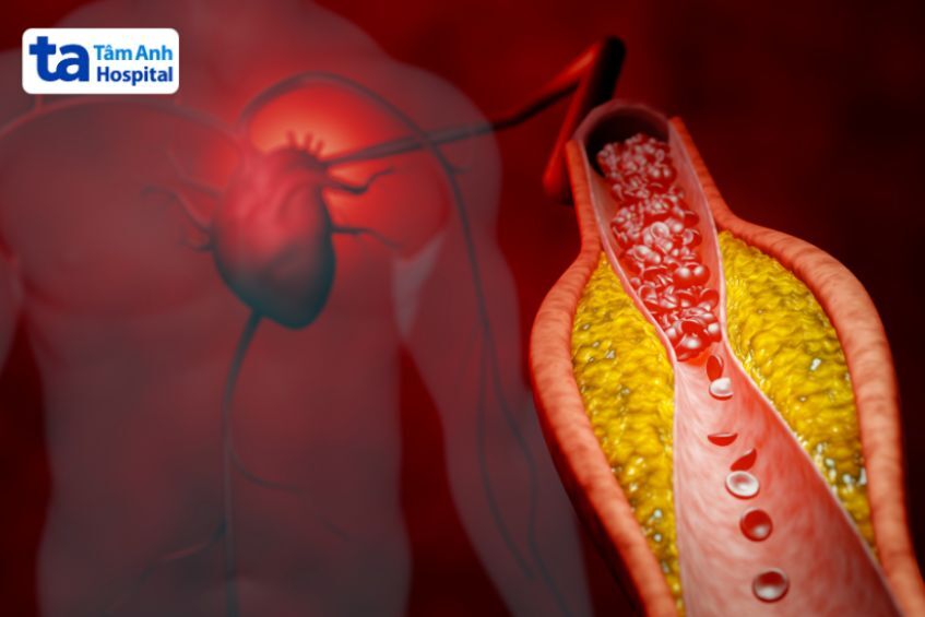 Tăng huyết áp thúc đẩy xơ vữa động mạch, giảm lưu lượng máu nuôi tim