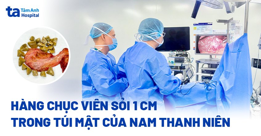 hàng chục viên sỏi 1 cm