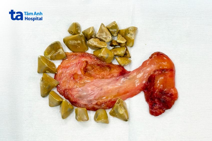 hàng chục viên sỏi kích thước lớn