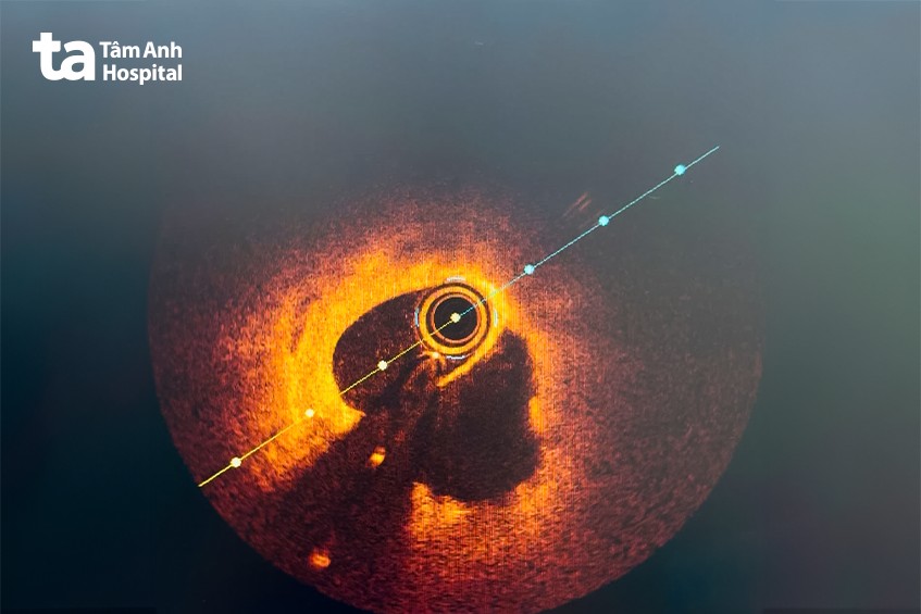 Hình ảnh chụp cắt lớp kết quang nội mạch cho thấy thủ phạm gây nhồi máu cơ tim là vỡ mảng xơ vữa