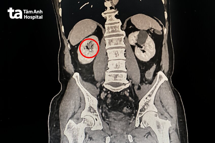 hình ảnh chụp ct khối u niệu mạc ở thận phải