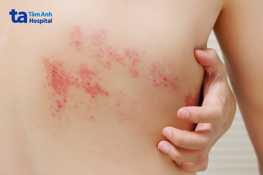 hình ảnh người bệnh mắc zona