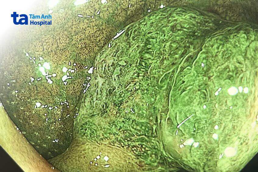 hình ảnh polyp của bệnh nhân
