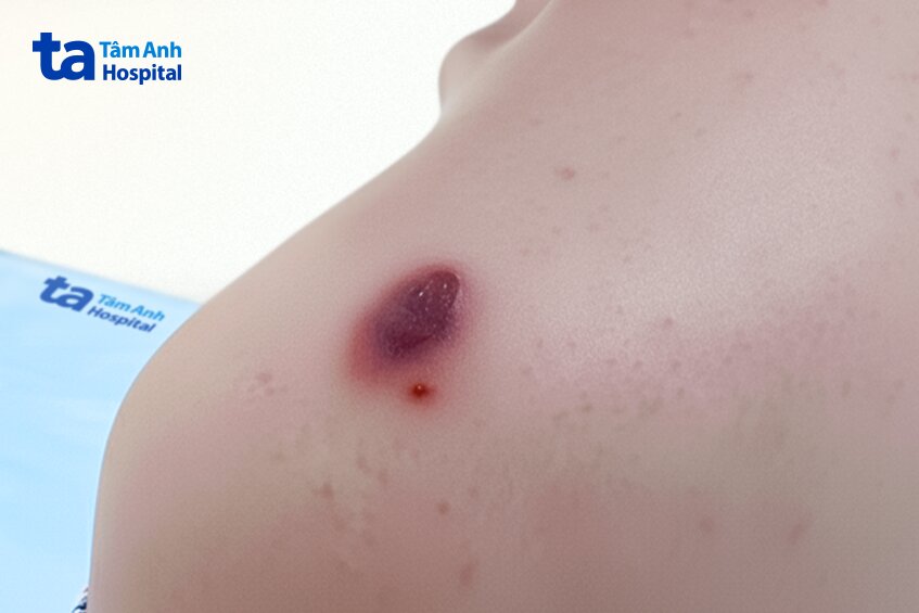 hình ảnh vết thương do vắt cắn