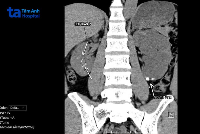 kết quả chụp cắt lớp vi tính