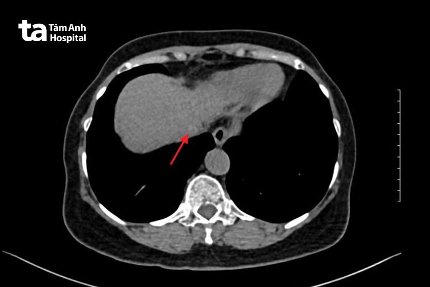 kết quả chụp mri của bà Bình
