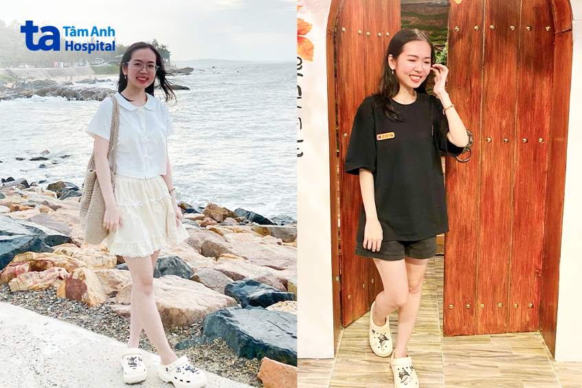khánh du trước và sau khi xóa cận