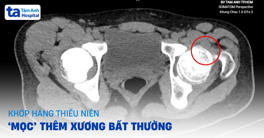 Cứng khớp háng do ‘mọc’ thêm xương bất thường