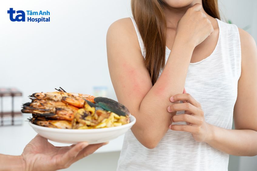 Nổi Mề Đay Sau Sinh Xử Lý Làm Sao An Toàn Cho Mẹ Và Bé? 4 Cần Kiêng Các Món Dễ Làm Dị Ứng