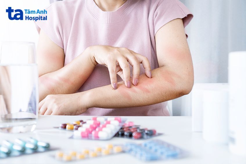 Người dị ứng hải sản nên mang thuốc dự phòng