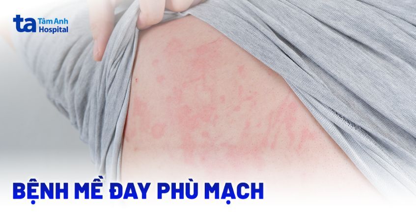 Mề đay phù mạch là gì? Nguyên nhân, dấu hiệu và hướng điều trị