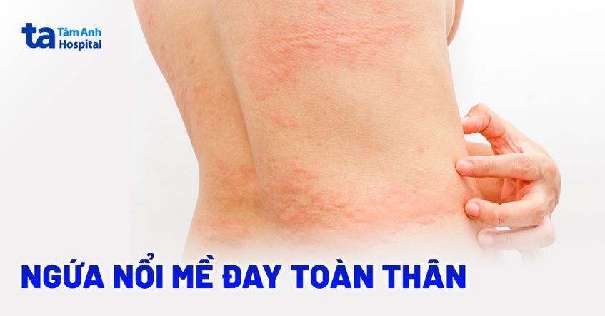 Lúc bị ngứa nổi mề đay toàn thân phải xử lý làm sao?