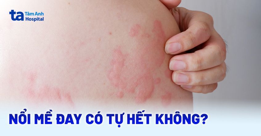 Nổi mề đay có tự hết không? Kéo dài bao lâu thì khỏi hẳn?