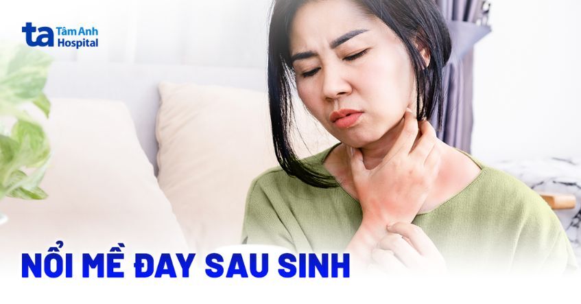 Nổi mề đay sau sinh xử lý làm sao an toàn cho mẹ và bé?