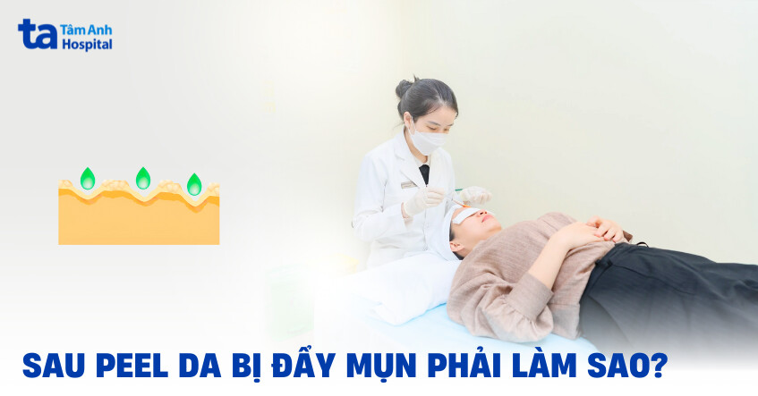 Peel da đẩy mụn và cách xử lý cồi mụn hiệu quả