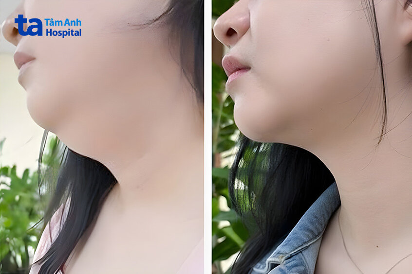 phần cằm của khách hàng sau 3 tháng điều trị
