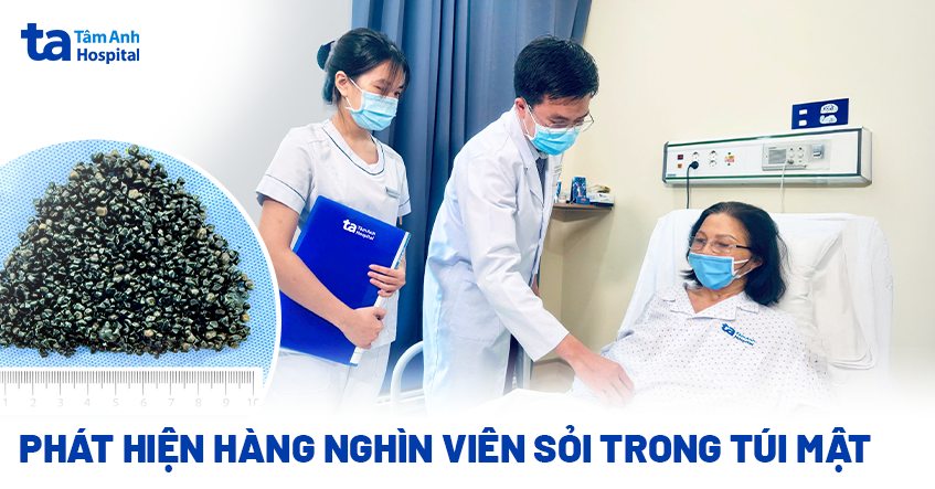 phát hiện hàng nghìn viên sỏi trong túi mật