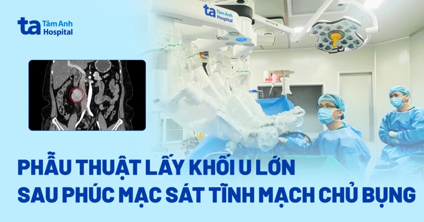 Phẫu thuật lấy khối u lớn sau phúc mạc sát tĩnh mạch chủ bụng