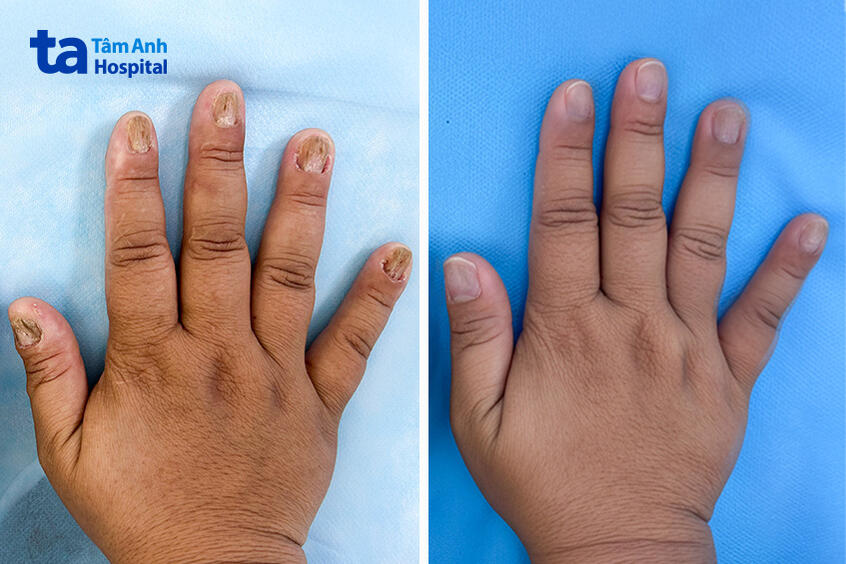 sau 8 lần bắn laser điều trị