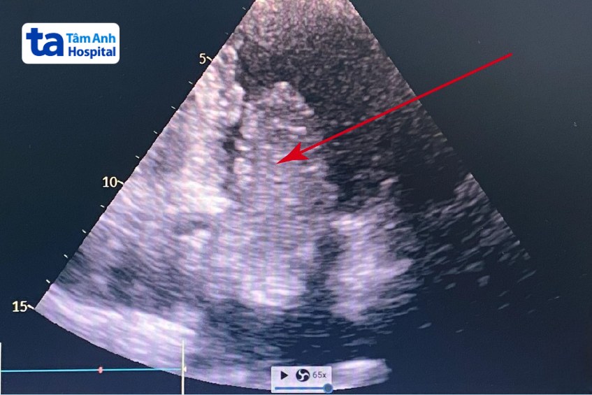 Siêu âm trước mổ cho thấy khối u nhầy nhĩ trái chui qua lỗ van hai lá đến mỏm tim