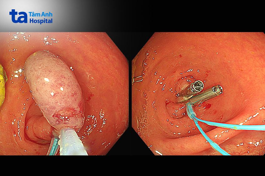 thắt gốc ruột thừa