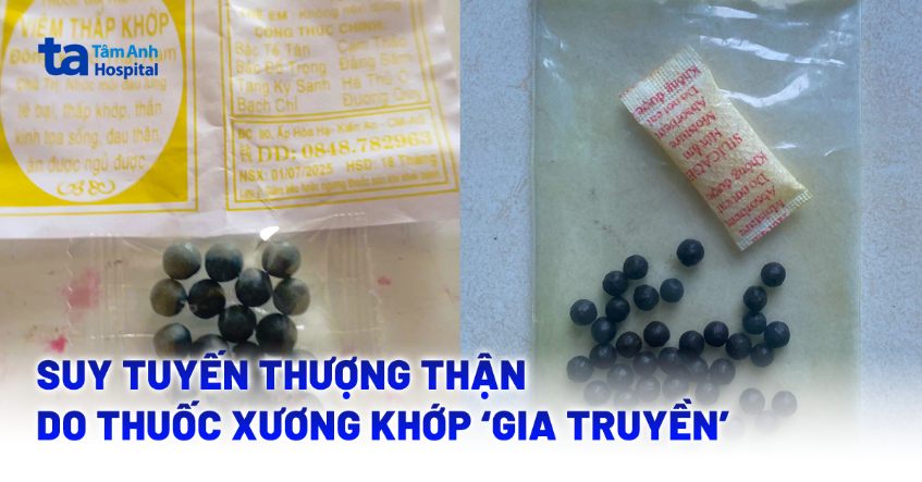 Thuốc xương khớp ‘gia truyền’ gây suy tuyến thượng thận