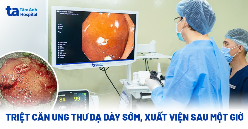 triệt căn ung thư dạ dày sớm