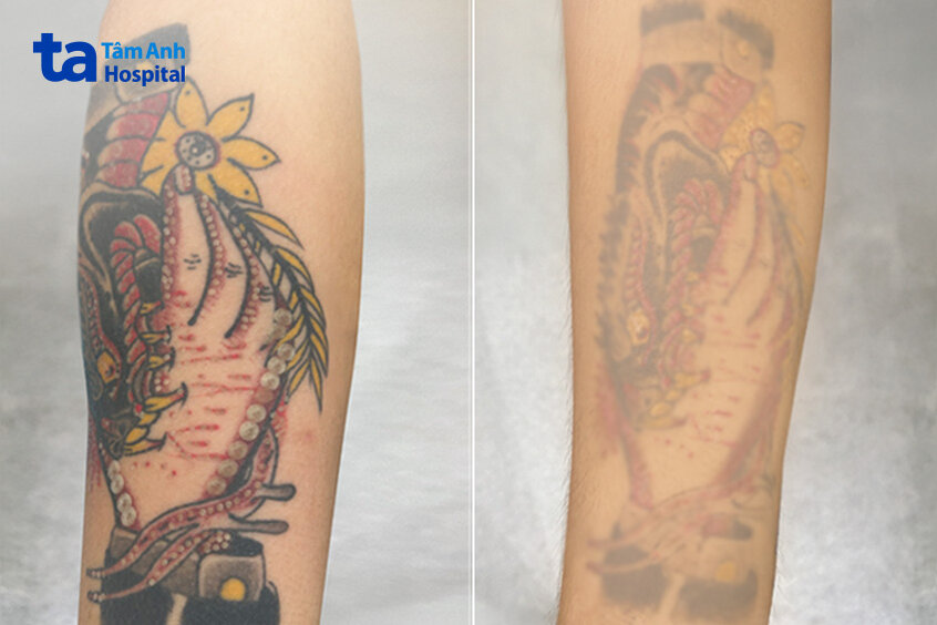 trước và sau 6 lần xóa xăm